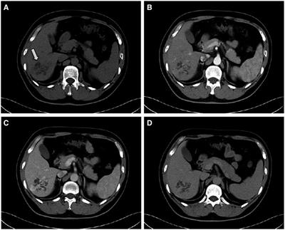 Characteristics of multicystic biliary hamartoma: A case report